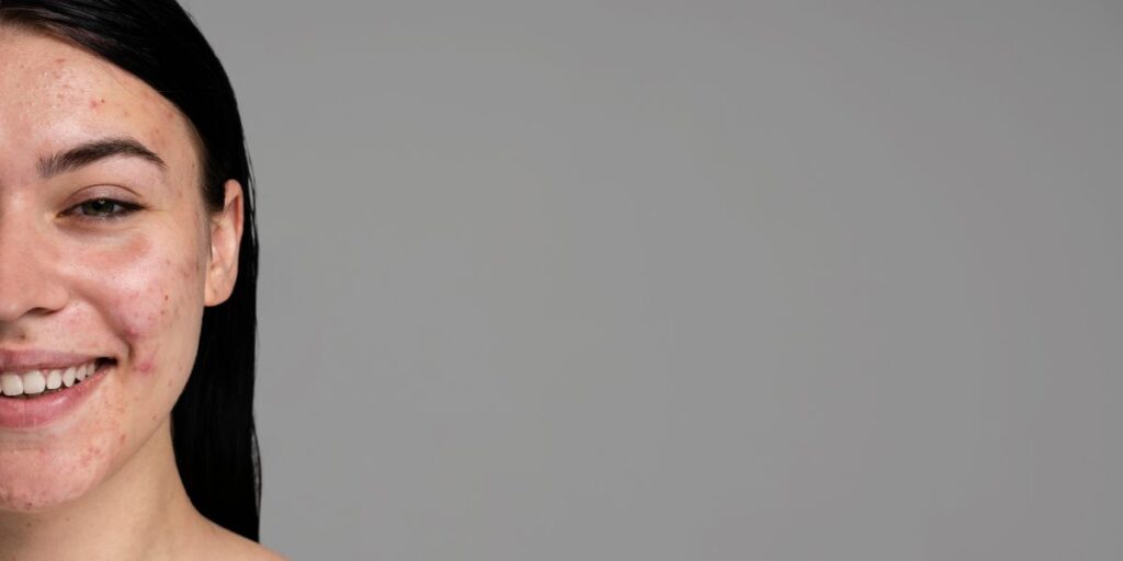 Fotografia de mulher caucasiana com pele acneica
