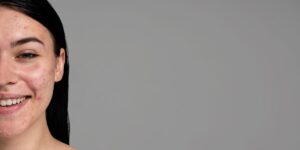 Fotografia de mulher caucasiana com pele acneica